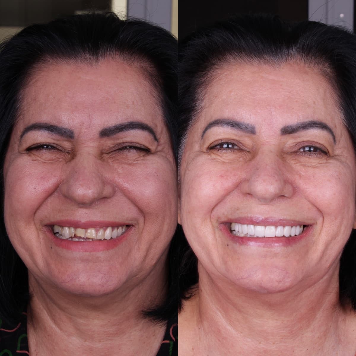 Comparação antes e depois do sorriso de uma paciente após tratamento com facetas de resina.