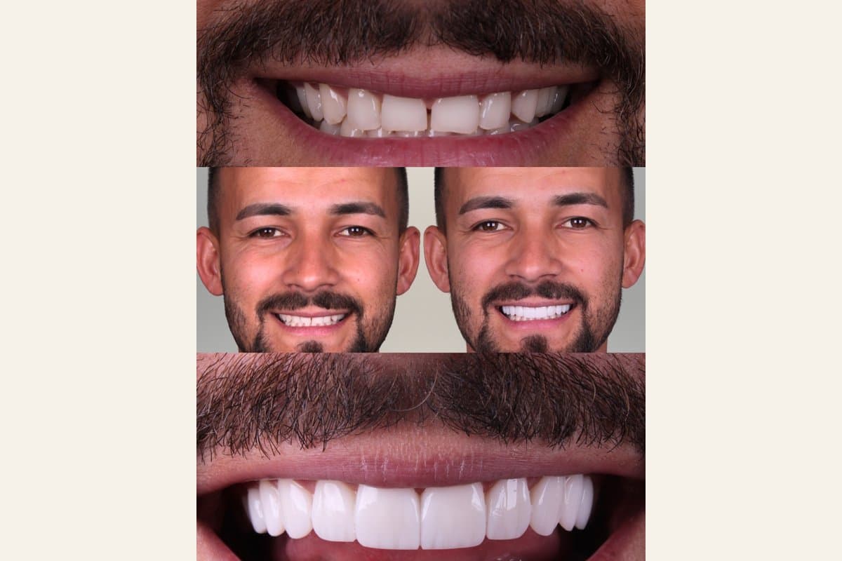 Composição com antes e depois facial e detalhe do sorriso masculino após facetas de resina.