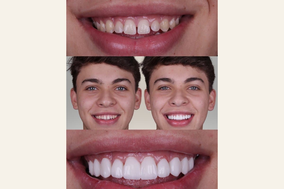 Antes e depois facial e aproximação dos dentes após tratamento estético com resina.