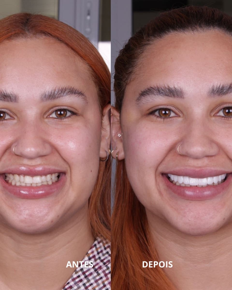 Comparação antes e depois de tratamento estético do sorriso