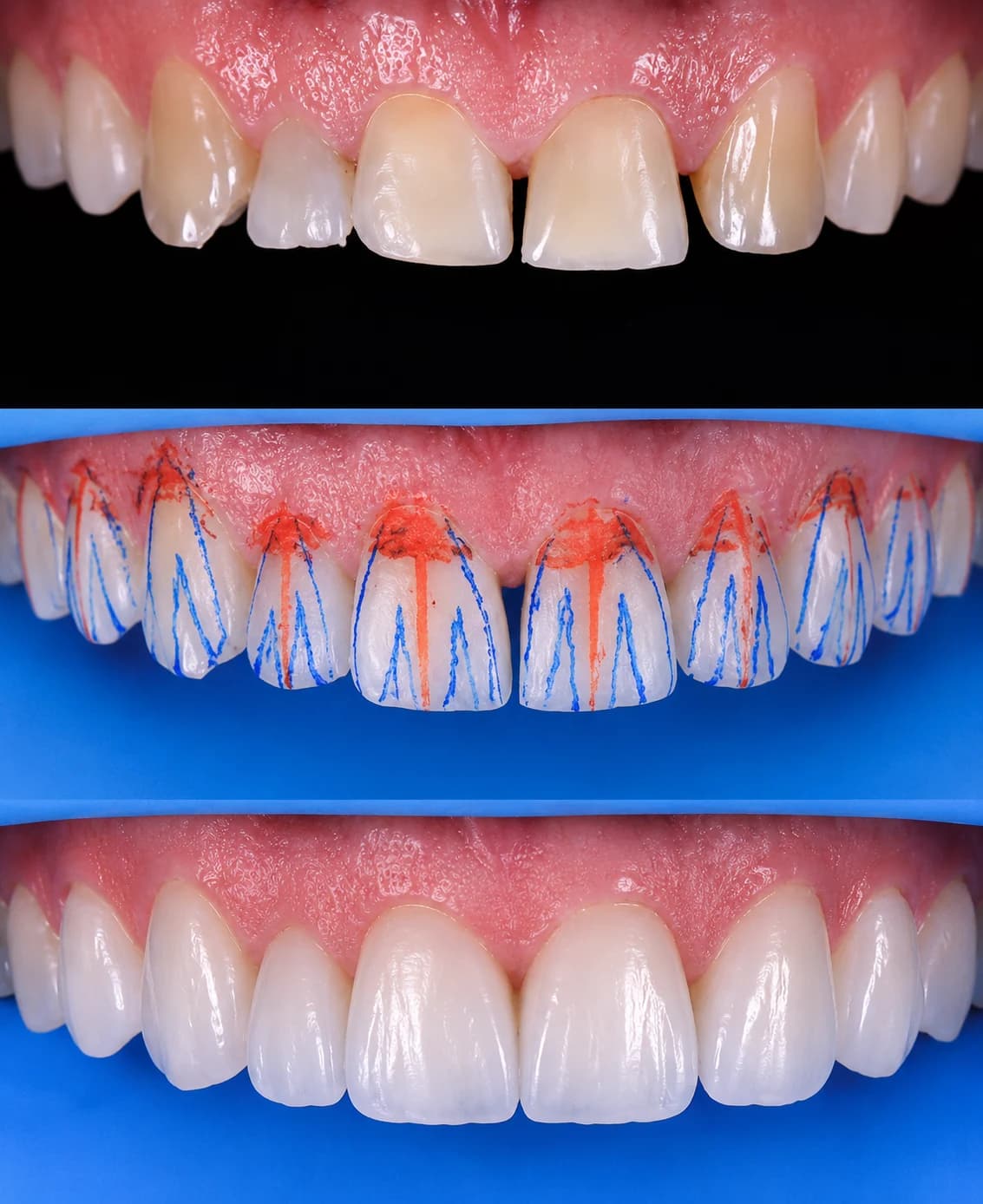 Sequência clínica mostrando os dentes antes, o planejamento anatômico e o resultado com facetas de resina