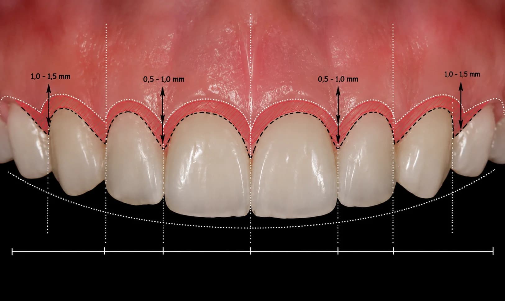 Planejamento clínico do contorno gengival e ósseo sobre os dentes anteriores